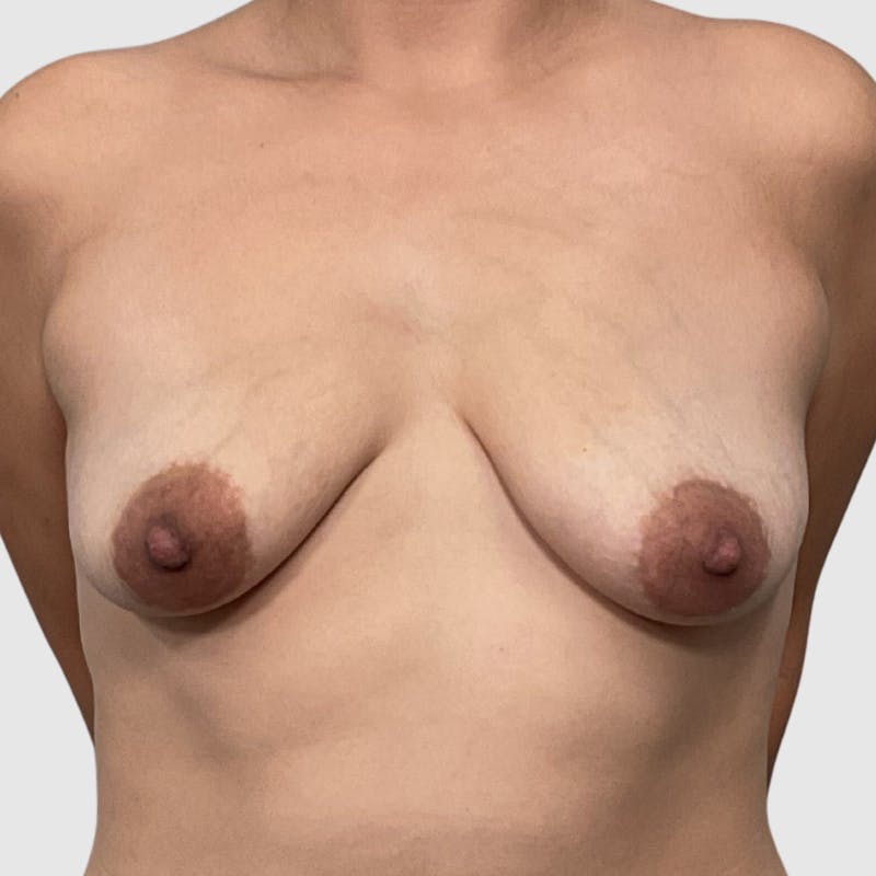 Breast Lift Before & After Gallery - Patient 119714 - Image 1
