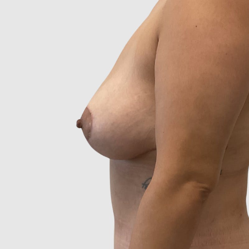 Breast Lift Before & After Gallery - Patient 187207 - Image 4
