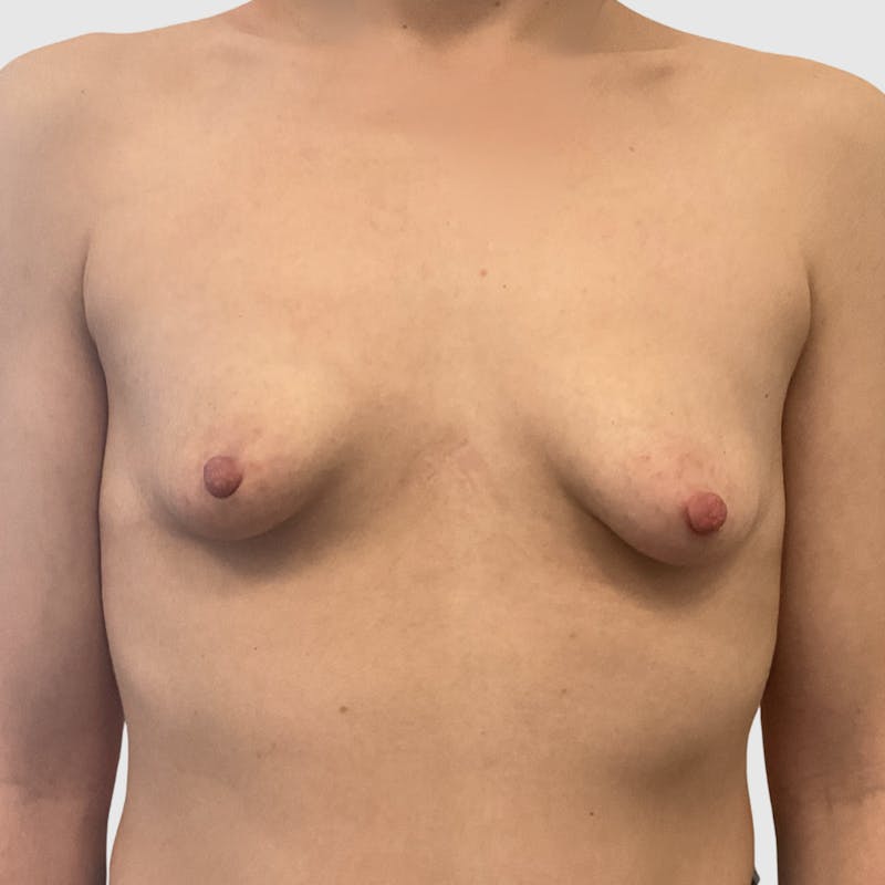 Breast Lift Before & After Gallery - Patient 272941 - Image 1