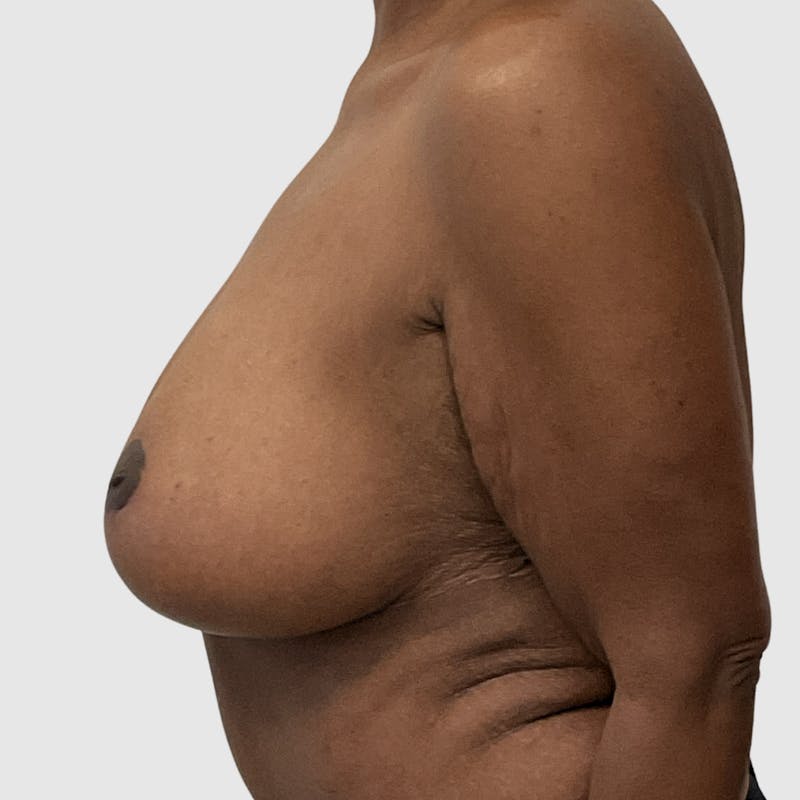 Breast Lift Before & After Gallery - Patient 348899 - Image 4