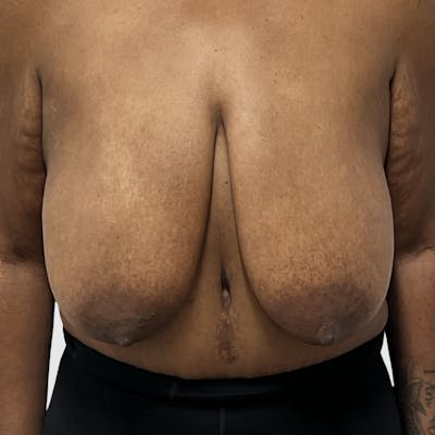 Breast Lift Before & After Gallery - Patient 348899 - Image 1