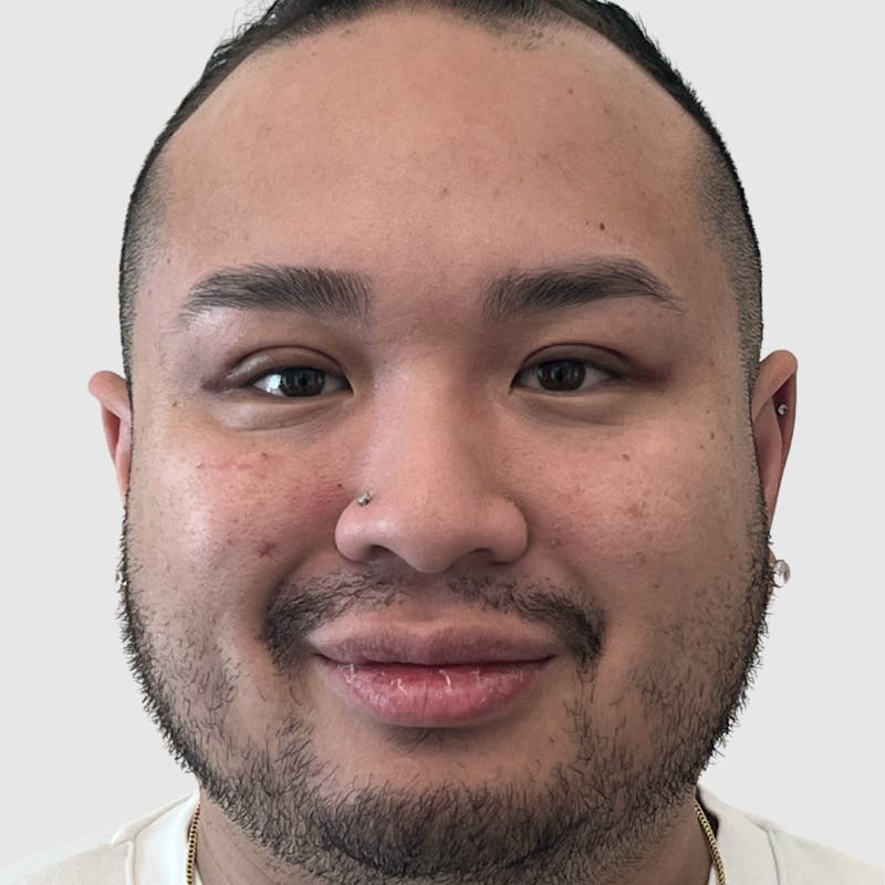 Blepharoplasty Before & After Gallery - Patient 382382 - Image 2