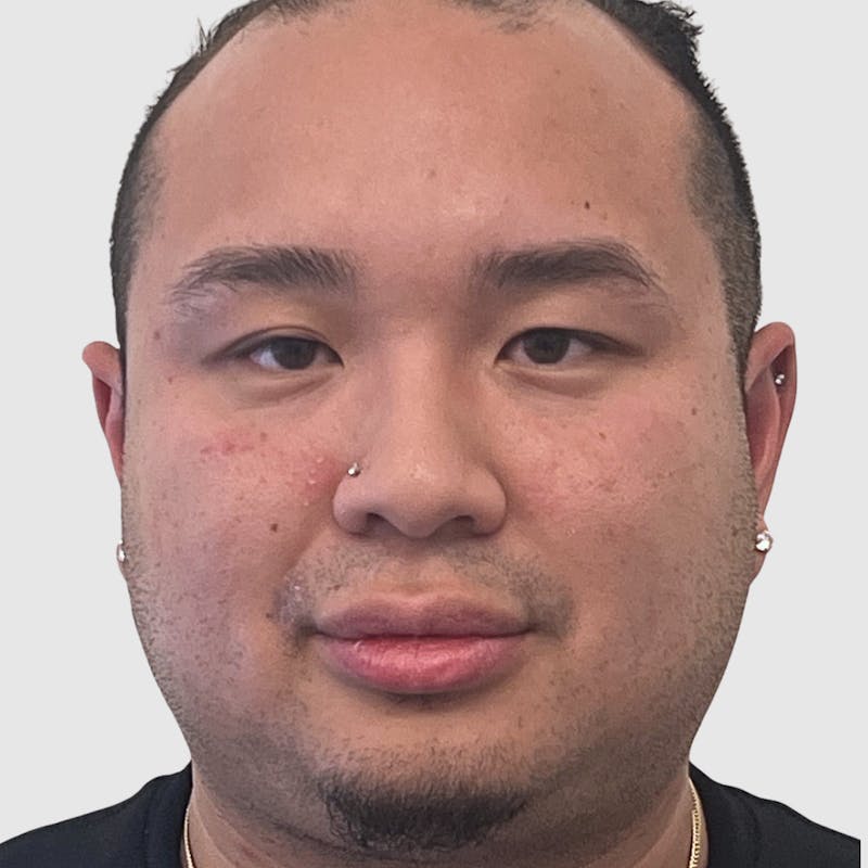 Blepharoplasty Before & After Gallery - Patient 382382 - Image 1