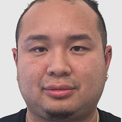 Blepharoplasty Before & After Gallery - Patient 382382 - Image 1