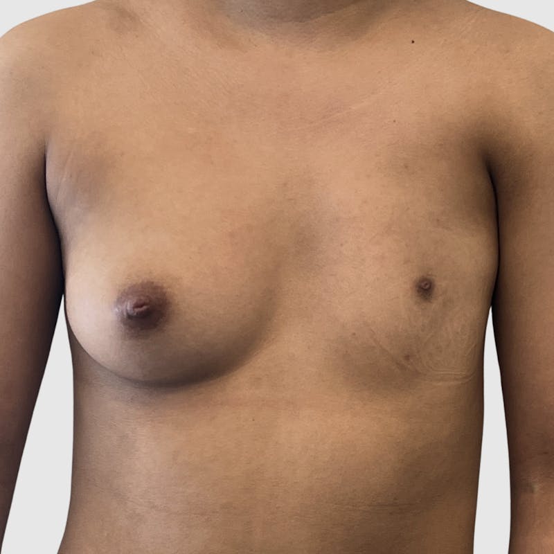 Breast Augmentation Before & After Gallery - Patient 266470 - Image 1