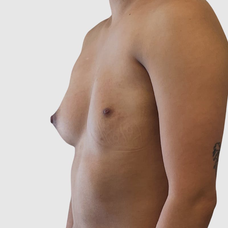 Breast Augmentation Before & After Gallery - Patient 266470 - Image 3