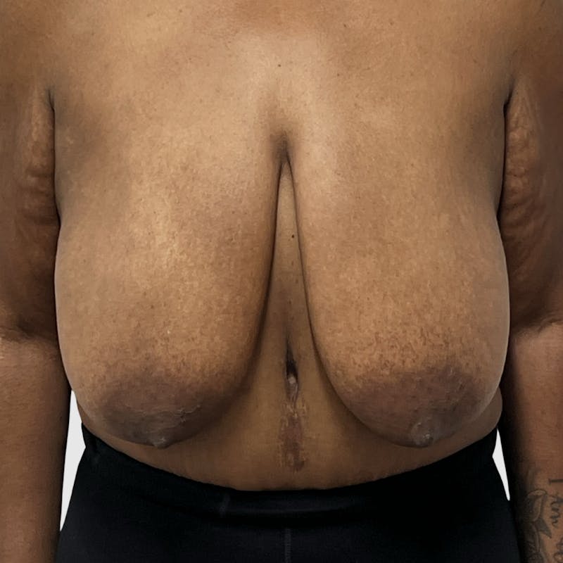 Breast Reduction Before & After Gallery - Patient 383531 - Image 1