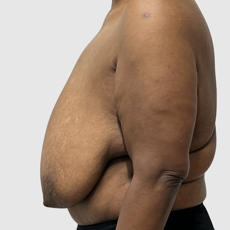 Breast Reduction Before & After Gallery - Patient 383531 - Image 3