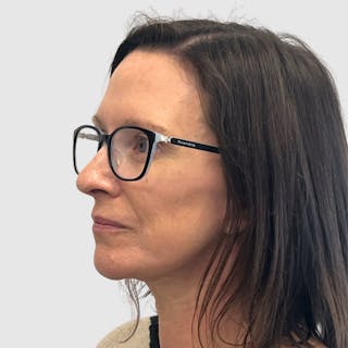 Face and Neck Lifts Before & After Gallery - Patient 424326 - Image 2