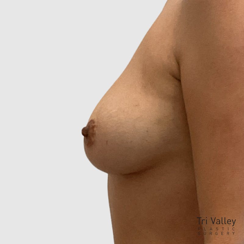 Fat Transfer Breast Augmentation Before & After Gallery - Patient 233237 - Image 4