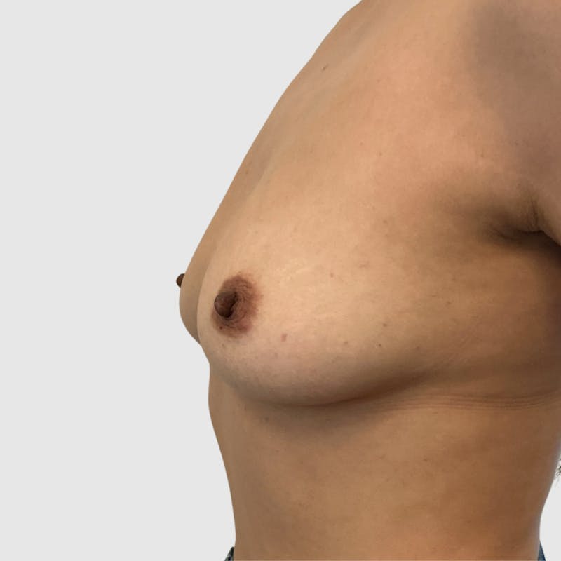 Fat Transfer Breast Augmentation Before & After Gallery - Patient 233237 - Image 3