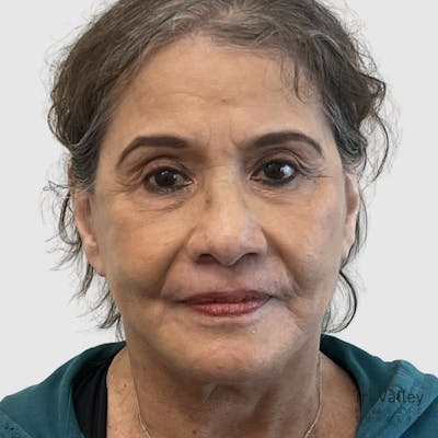 Laser Skin Resurfacing Before & After Gallery - Patient 324638 - Image 2