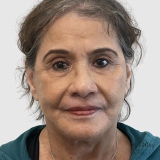 Fat Transfer Face Before & After Gallery - Patient 190327 - Image 2