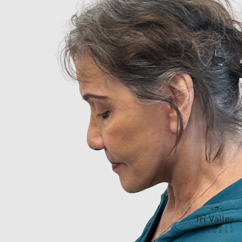 Laser Skin Resurfacing Before & After Gallery - Patient 324638 - Image 6