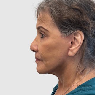 Fat Transfer Face Before & After Gallery - Patient 190327 - Image 4