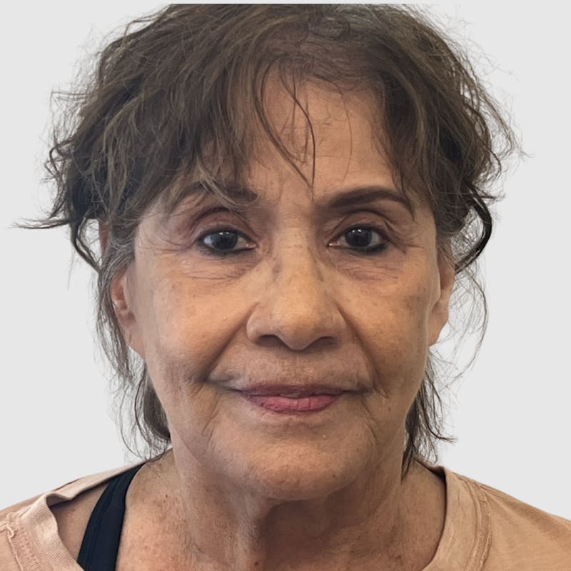 Laser Skin Resurfacing Before & After Gallery - Patient 324638 - Image 1