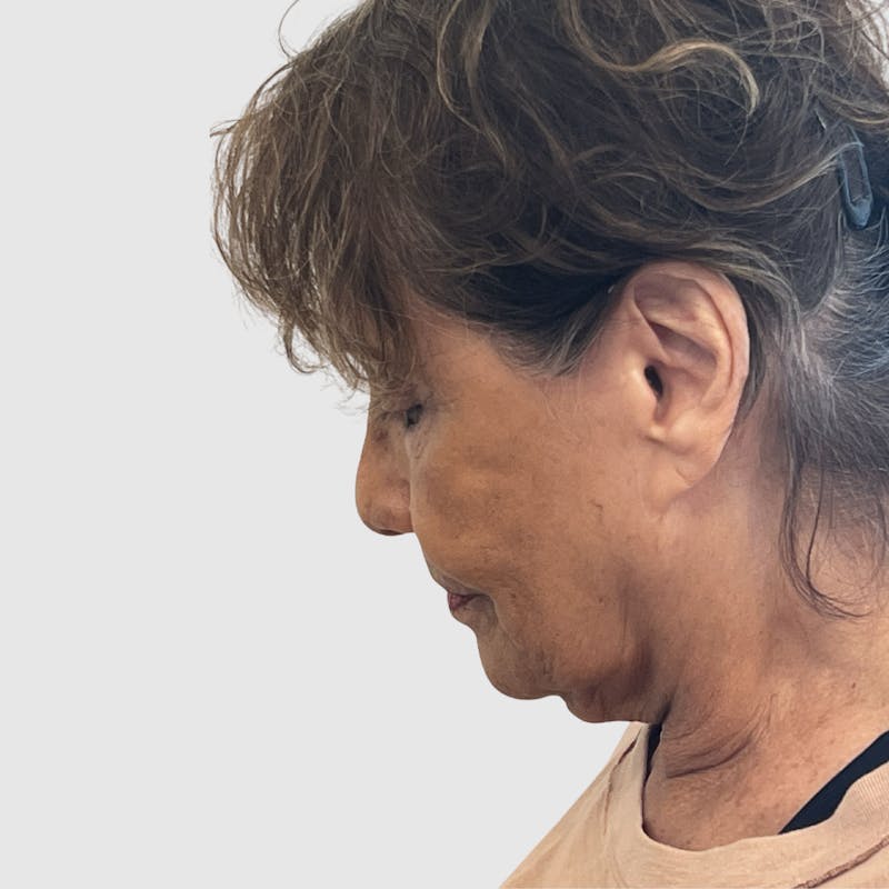 Laser Skin Resurfacing Before & After Gallery - Patient 324638 - Image 5