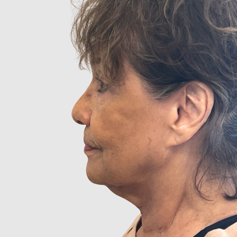 Laser Skin Resurfacing Before & After Gallery - Patient 324638 - Image 3
