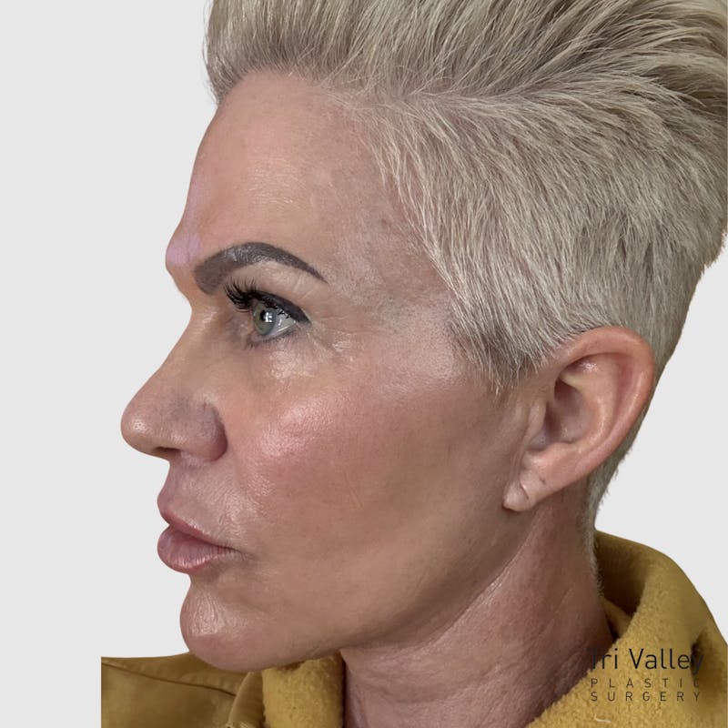 Laser Skin Resurfacing Before & After Gallery - Patient 388626 - Image 4