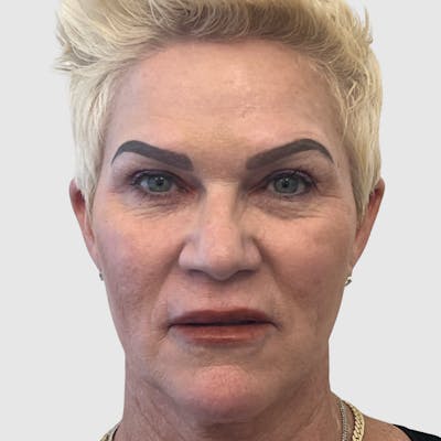 Laser Skin Resurfacing Before & After Gallery - Patient 388626 - Image 1