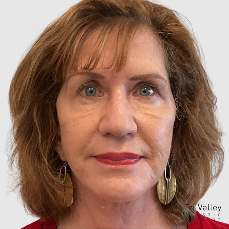 Fat Transfer Face Before & After Gallery - Patient 106406 - Image 2