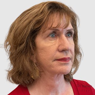 Fat Transfer Face Before & After Gallery - Patient 106406 - Image 6