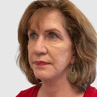 Fat Transfer Face Before & After Gallery - Patient 106406 - Image 4