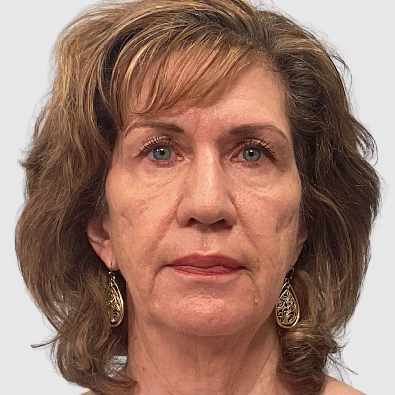 Fat Transfer Face Before & After Gallery - Patient 106406 - Image 1