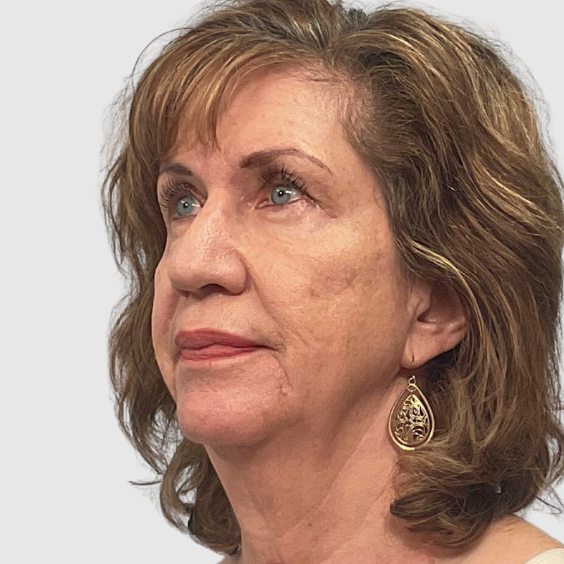 Fat Transfer Face Before & After Gallery - Patient 106406 - Image 3