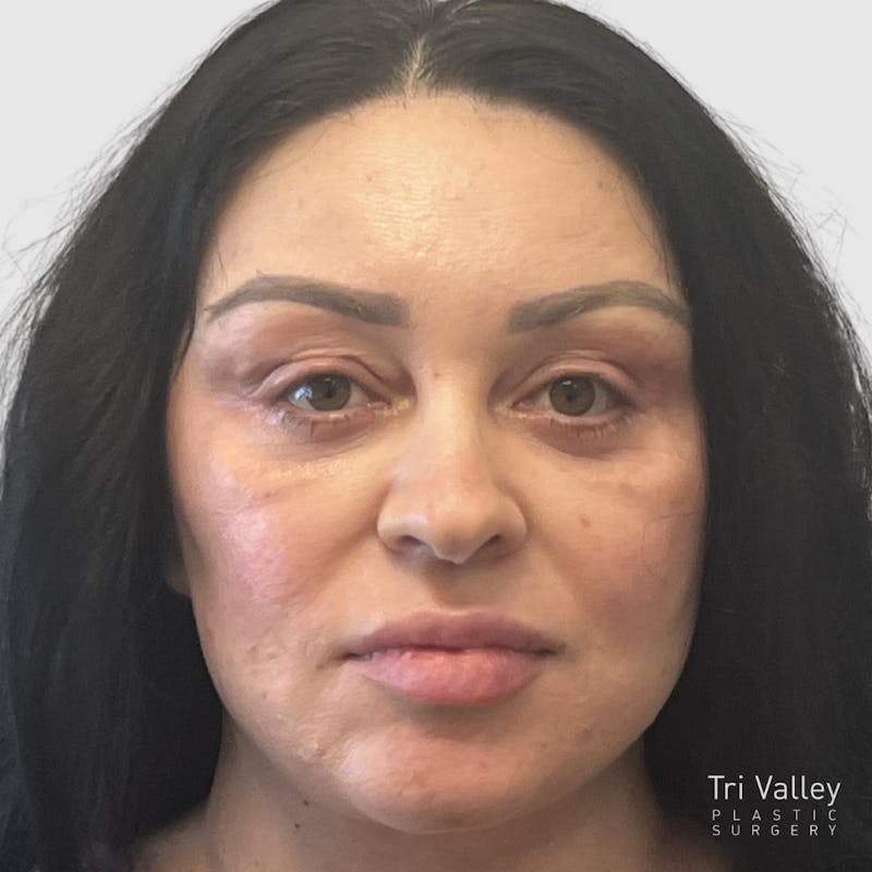 Fat Transfer Face Before & After Gallery - Patient 115688 - Image 2