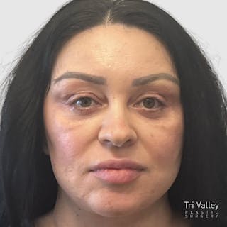 Fat Transfer Face Before & After Gallery - Patient 115688 - Image 2
