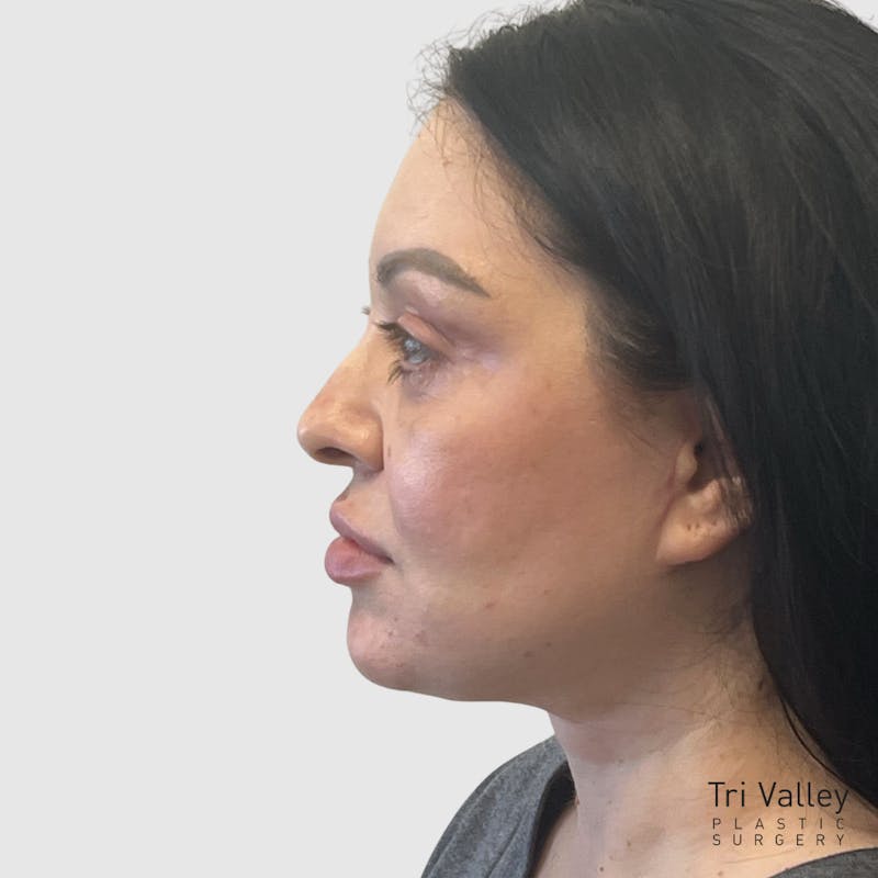 Fat Transfer Face Before & After Gallery - Patient 115688 - Image 6