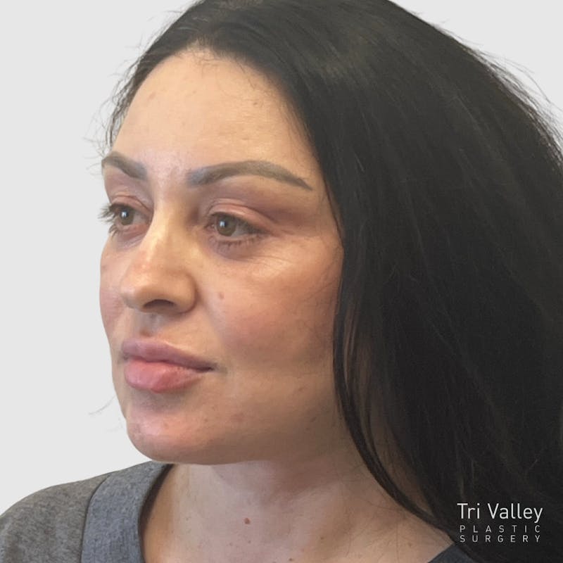 Fat Transfer Face Before & After Gallery - Patient 115688 - Image 4