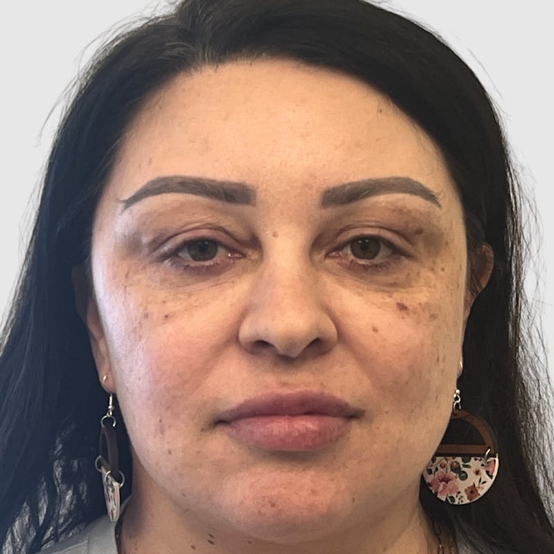 Fat Transfer Face Before & After Gallery - Patient 115688 - Image 1