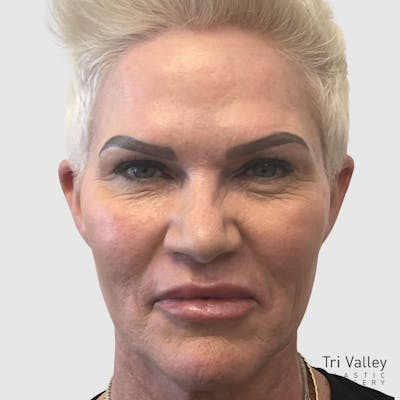 Lip Lift Before & After Gallery - Patient 426161 - Image 2