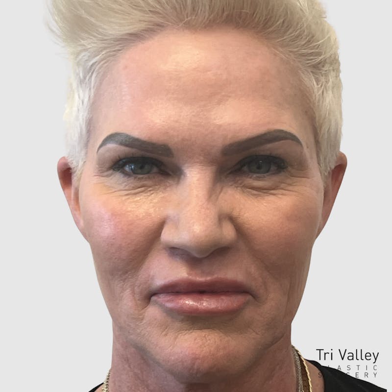 Lip Lift Before & After Gallery - Patient 426161 - Image 2