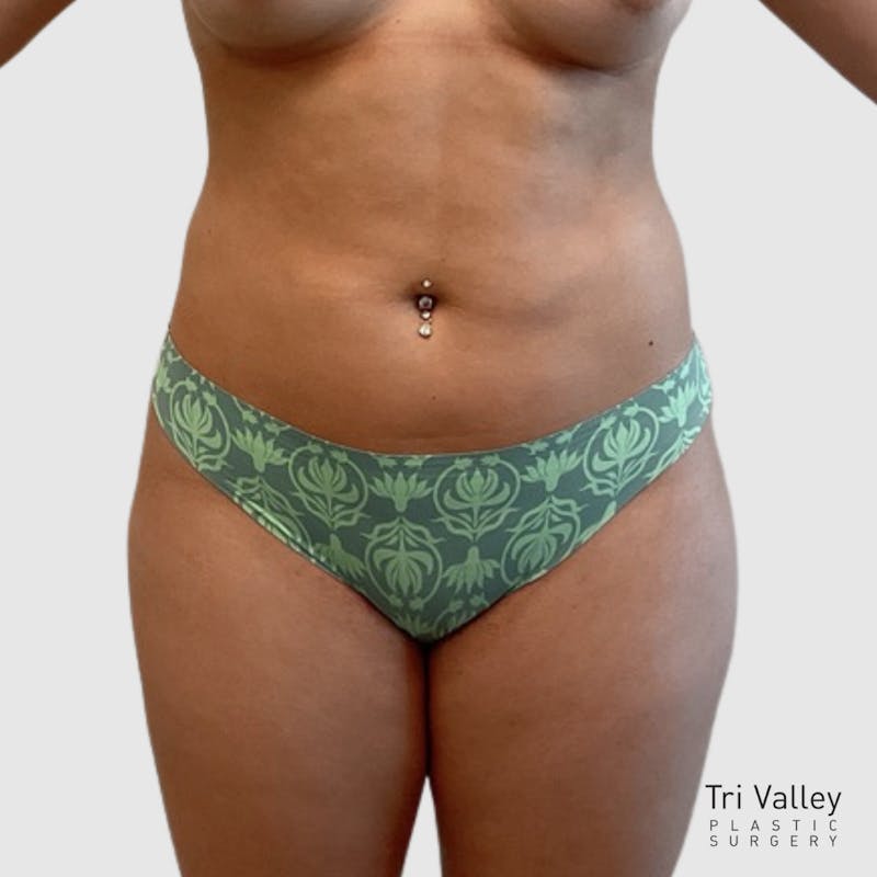 Brazilian Butt Lift Before & After Gallery - Patient 205407 - Image 2