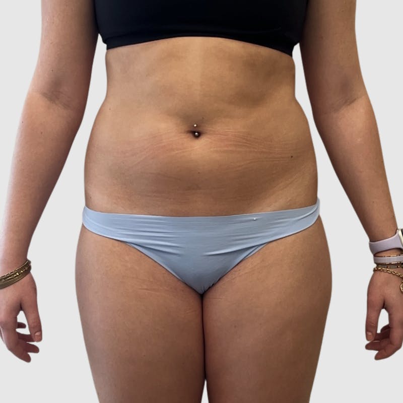 Brazilian Butt Lift Before & After Gallery - Patient 205407 - Image 1