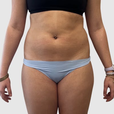 Brazilian Butt Lift Before & After Gallery - Patient 205407 - Image 1