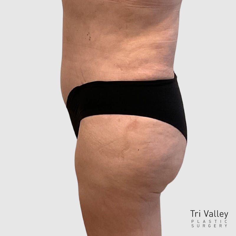 Brazilian Butt Lift Before & After Gallery - Patient 356837 - Image 4