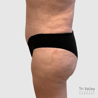 Brazilian Butt Lift Before & After Gallery - Patient 356837 - Image 4