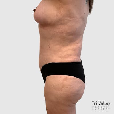 Brazilian Butt Lift Before & After Gallery - Patient 356837 - Image 2