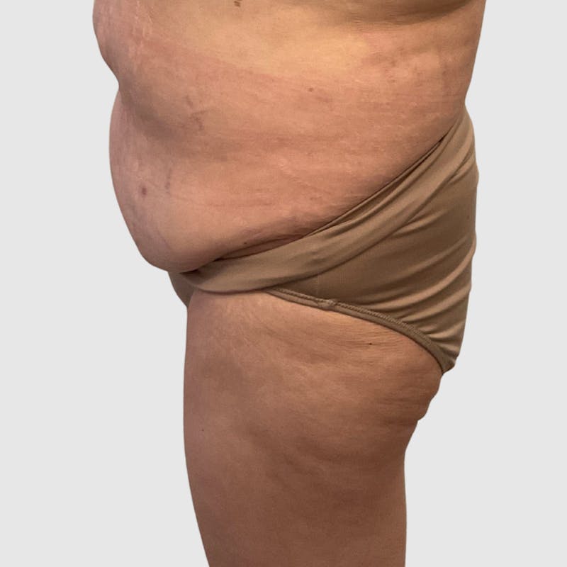 Brazilian Butt Lift Before & After Gallery - Patient 356837 - Image 3