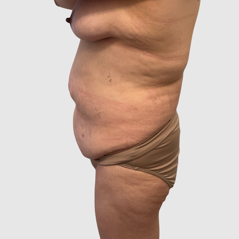 Brazilian Butt Lift Before & After Gallery - Patient 356837 - Image 1