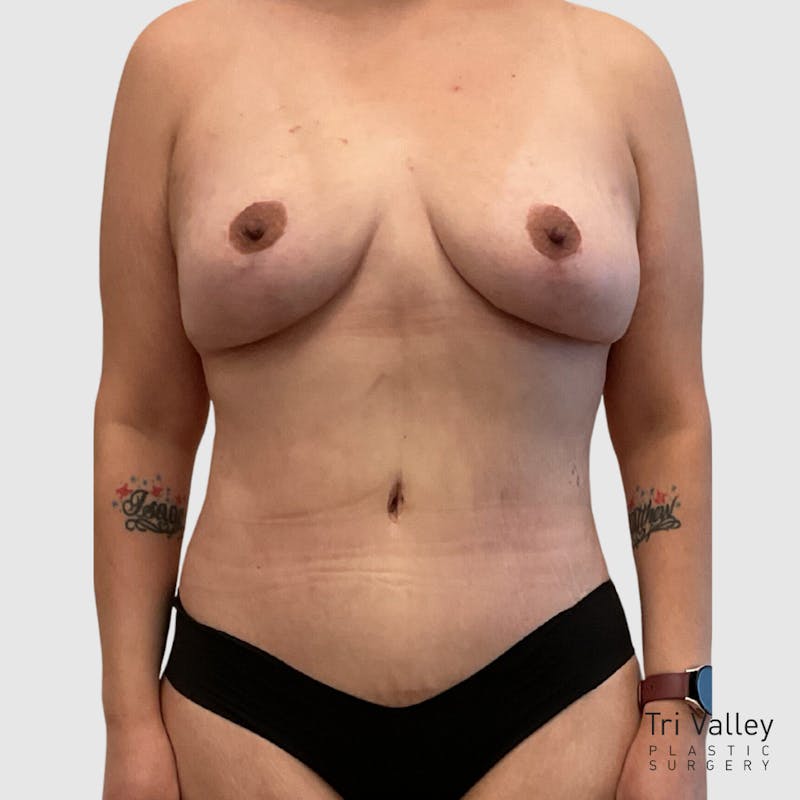 Mommy Makeover Before & After Gallery - Patient 231949 - Image 2