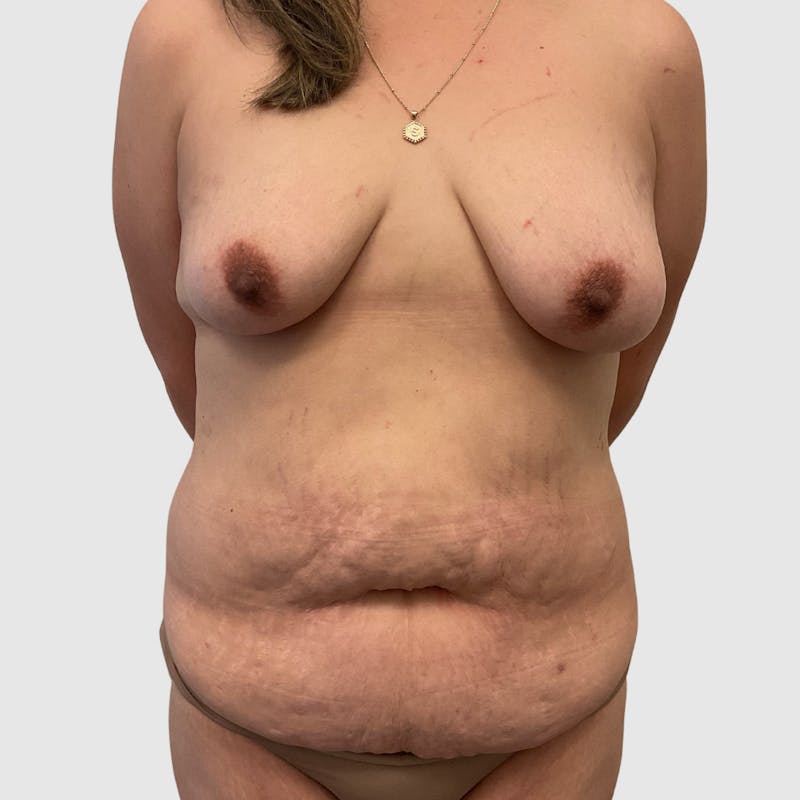 Mommy Makeover Before & After Gallery - Patient 231949 - Image 1