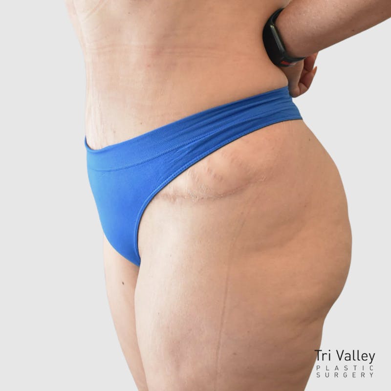 Mommy Makeover Before & After Gallery - Patient 426684 - Image 6