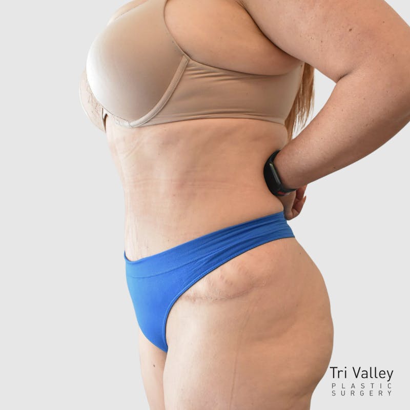 Mommy Makeover Before & After Gallery - Patient 426684 - Image 4