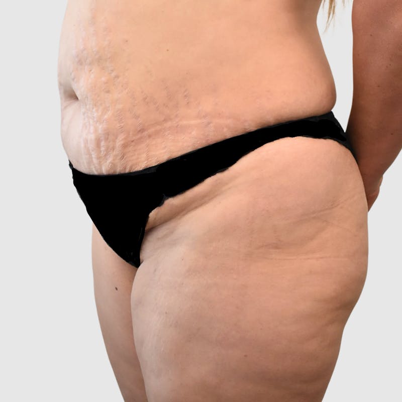 Mommy Makeover Before & After Gallery - Patient 426684 - Image 5