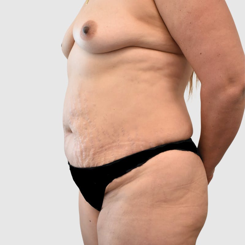 Mommy Makeover Before & After Gallery - Patient 426684 - Image 3